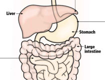 Boston Globe, infographic, Carolyn Johnson, obesity, endobarrier, Attiva, Zafgen